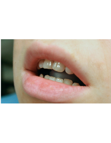 Open Bite – Dispositivo per Morso Aperto MFS