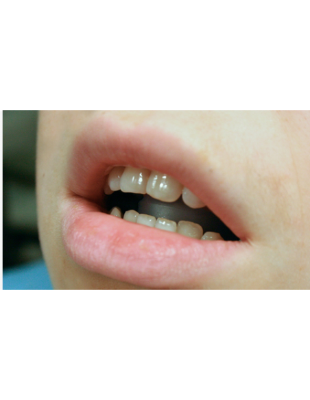 Open Bite – Dispositivo per Morso Aperto MFS