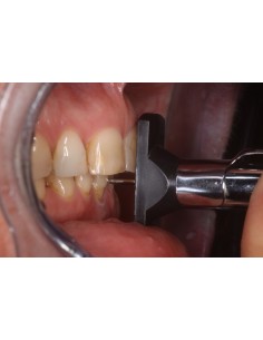 Overjet Meter – Strumento per la misurazione dell’overjet