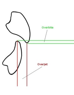 Overjet Meter – Strumento per la misurazione dell’overjet