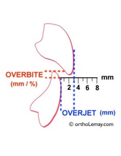 Overjet Meter – Strumento per la misurazione dell’overjet