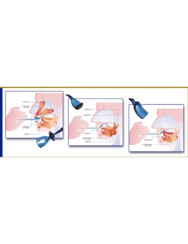 Kit OraLight adulti per esercizi oro-motori